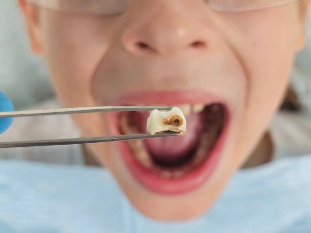 Best Emergency Tooth Extraction in Rogersville, MO